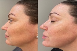 Skin Toning Treatment before & after