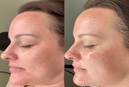 Skin Toning Treatment before and after