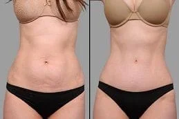 Stretch-Marks-Removal-Before-After