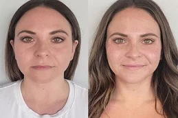 Volift Fillers After and Before