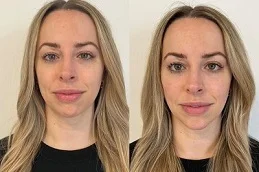 Volift Fillers Before and After