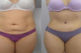 after and before Adipose Lipolysis Injections