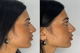 before and after Cheek Augmentation