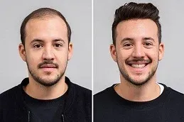 before and after Hybrid Hair Transplant