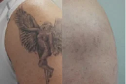 before and after Picosure Tattoo Removal