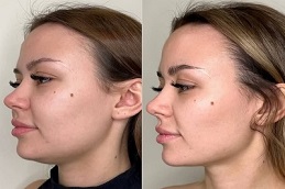before and after Skin Toning Treatment