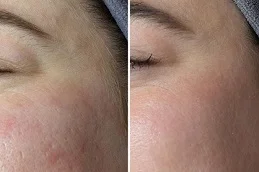 before and after hypertrophic scars treatment