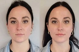 before and after sculptra fillers