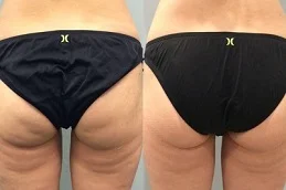 butt fillers befor & after