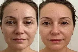 cosmelan peel after and before