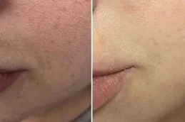 hypertrophic scars treatment after and before