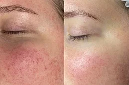 hypertrophic scars treatment before and after