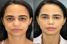 sculptra fillers after and before