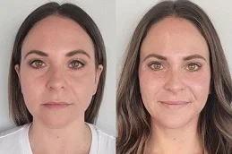 sculptra fillers before and after