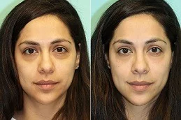under eye after and before