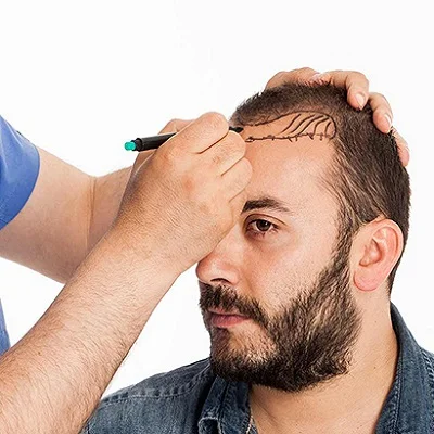 زراعة الشعر الهجينة