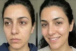 After and Before laser skin resurfacing