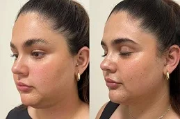 Before and After Belkyra Treatment
