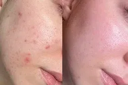 Before and After Derma Roller Treatment