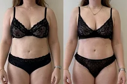 Before and After Laser Fat Reduction