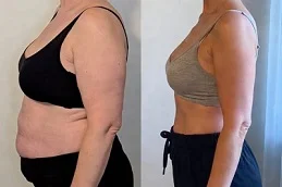 Before and After Saxenda Injections