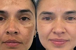 Before and After Spectra Laser Carbon Peel