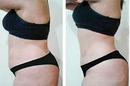 Before and After Velashape 3 Treatment