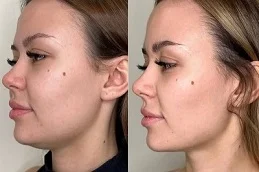 Belkyra Treatment After and Before