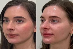Belkyra Treatment Before and After