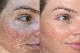 Derma Roller Treatment After and Before