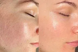 Derma Roller Treatment Before and After