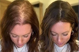 Female Hair Transplant Before and After
