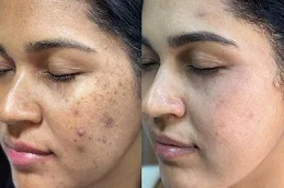 Salicylic Acid Peeling Before and After