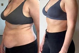 Saxenda Injections After and Before