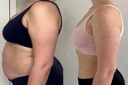 Saxenda Injections Before and After