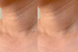 Skin Tag Removal after and Before