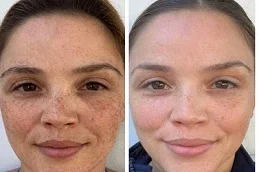 Spectra Laser Carbon Peel After and Before