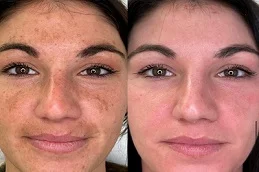 Spectra Laser Carbon Peel Before and After