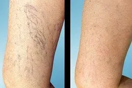 After and Before Varicose Vains Treatment 
