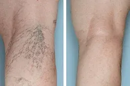 Varicose Vains Treatment After and Before