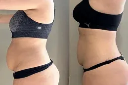 Velashape 3 Treatment After and Before