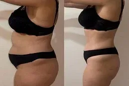 Velashape 3 Treatment Before and After