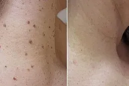 after and Before skin tag removal