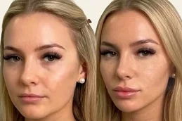 laser skin resurfacing After and Before