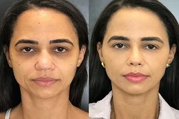 laser skin resurfacing Before and After