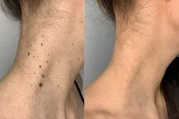 skin tag removal Before and After