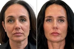 sunekos injection Before and After