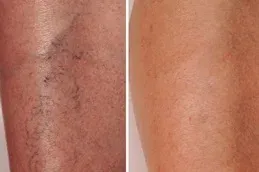 varicose vain Treatment Before and After