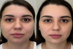 After & Before HydraFacial