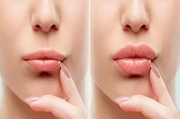 After and Befor Lip Fillers Injection